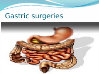 gastric surgery.pptx